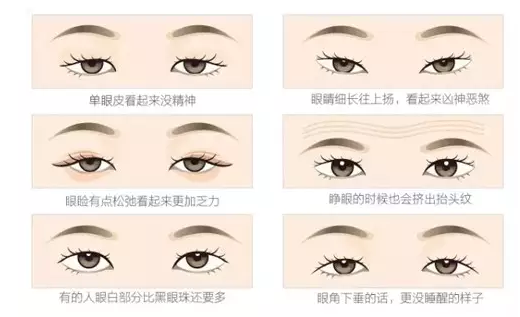 關于重瞼術，你要了解的那些事兒