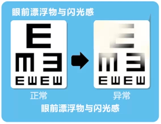 視網(wǎng)膜脫離啥癥狀？這張圖告訴你！