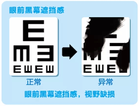 視網(wǎng)膜脫離啥癥狀？這張圖告訴你！