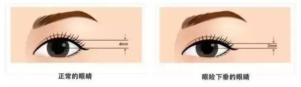 為什么要做雙眼皮？5個(gè)理由說服你！