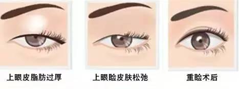 為什么要做雙眼皮？5個(gè)理由說服你！