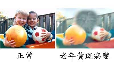 老年黃斑變性如何預防