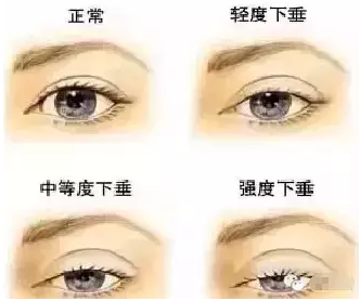 “美目貼”別依賴，小心眼皮下垂