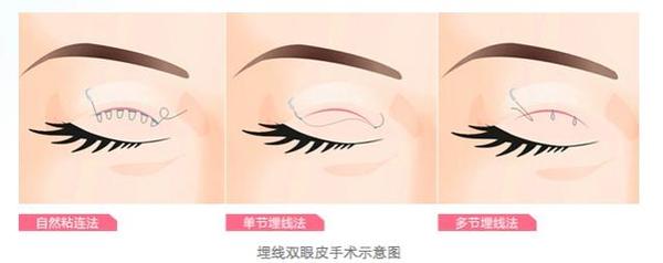 眼整形的恢復(fù)期是多長(zhǎng)？你肯定想知道！