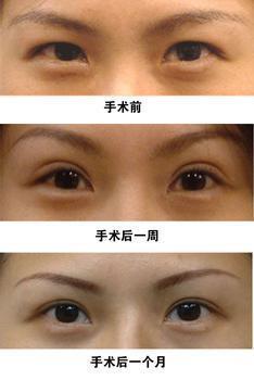 眼整形的恢復(fù)期是多長(zhǎng)？你肯定想知道！