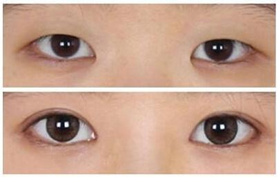 眼整形的恢復(fù)期是多長(zhǎng)？你肯定想知道！