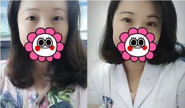 要不要做雙眼皮？別糾結(jié)了看這個！