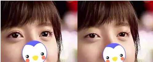 要不要做雙眼皮？別糾結(jié)了看這個！