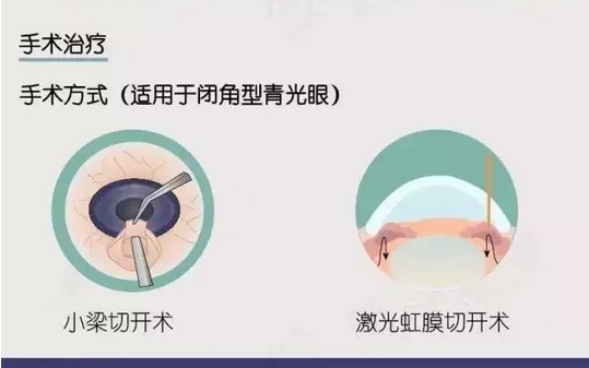 【看圖說(shuō)】一分鐘帶您了解青光眼