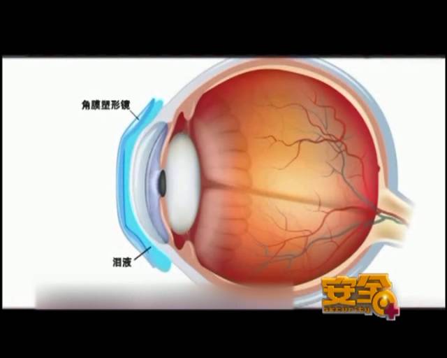 一夜之間真的能改變視力嗎？