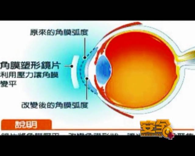 一夜之間真的能改變視力嗎？