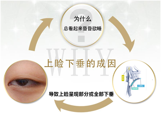 拯救惺忪睡眼，告別上瞼下垂！