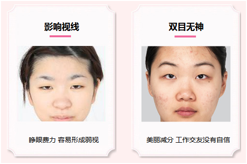 拯救惺忪睡眼，告別上瞼下垂！