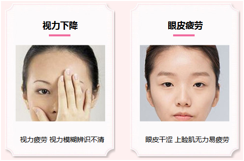 拯救惺忪睡眼，告別上瞼下垂！