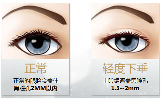 拯救惺忪睡眼，告別上瞼下垂！