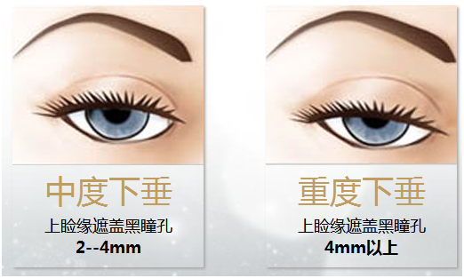 拯救惺忪睡眼，告別上瞼下垂！