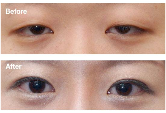 拯救惺忪睡眼，告別上瞼下垂！