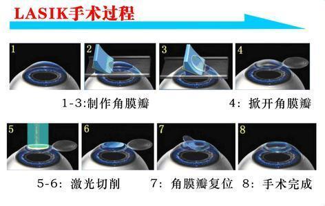 他們很有錢，但寧愿戴眼鏡都不做近視手術(shù)