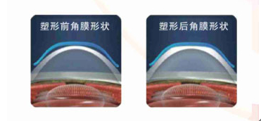 普瑞眼科視力安心七彩會員俱樂部圓滿舉行！