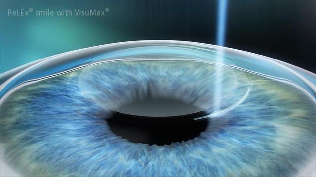 5折近視手術(shù)，1元秒殺，三月摘鏡優(yōu)惠攻略給你！