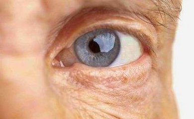 白內(nèi)障患者應(yīng)該如何選擇人工晶體？