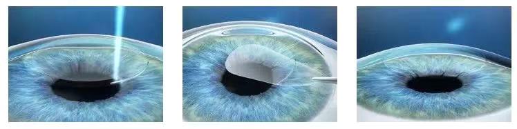 如果眼睛近視了該怎么？