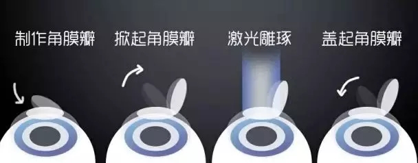 激光近視矯正和ICL晶體植入近視矯正攻略，