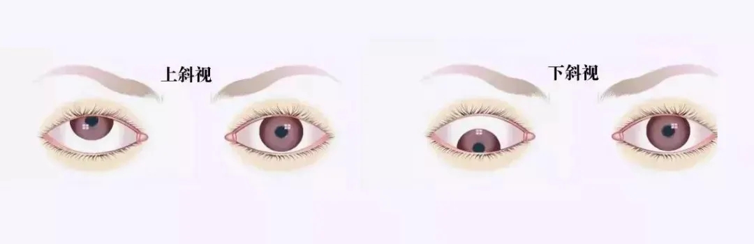 關(guān)于斜視，這幾個誤區(qū)害人不淺!