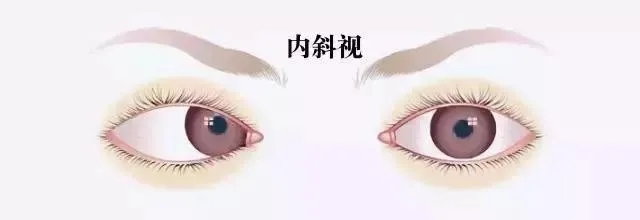 關(guān)于斜視，這幾個誤區(qū)害人不淺!