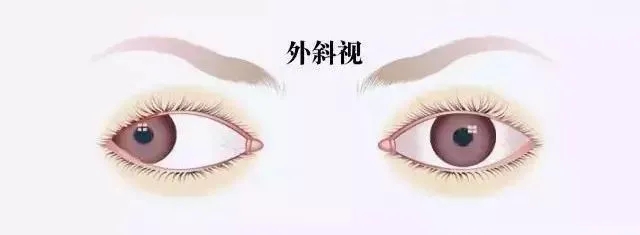 關(guān)于斜視，這幾個誤區(qū)害人不淺!