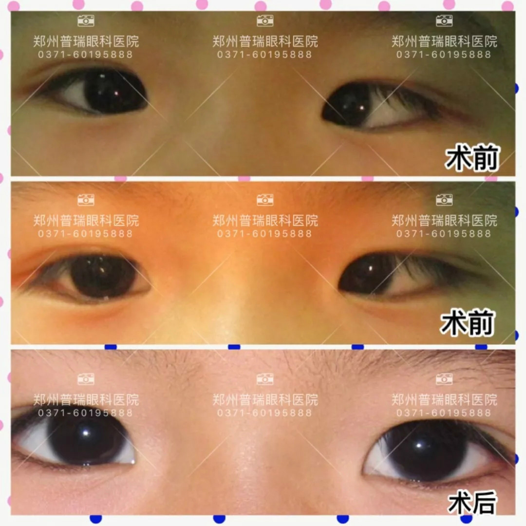 關(guān)于斜視，這幾個誤區(qū)害人不淺!