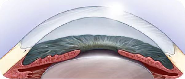 微雕優(yōu)視飛秒，重新定義角膜屈光手術(shù)，讓視力多看一行！