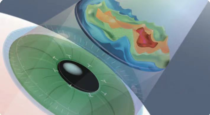 微雕優(yōu)視飛秒，重新定義角膜屈光手術(shù)，讓視力多看一行！