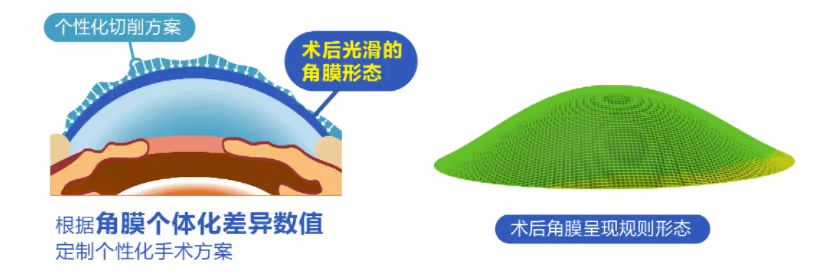 微雕優(yōu)視飛秒，重新定義角膜屈光手術(shù)，讓視力多看一行！