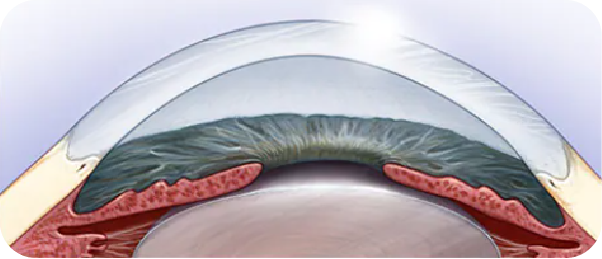 微雕優(yōu)視飛秒，重新定義角膜屈光手術(shù)，讓視力多看一行！