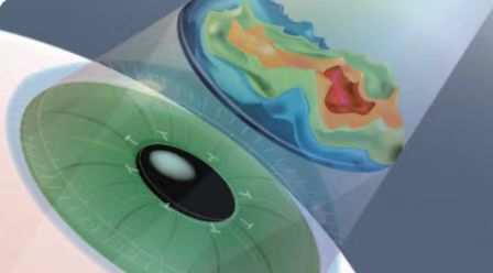 微雕優(yōu)視飛秒，重新定義角膜屈光手術(shù)，讓視力多看一行！