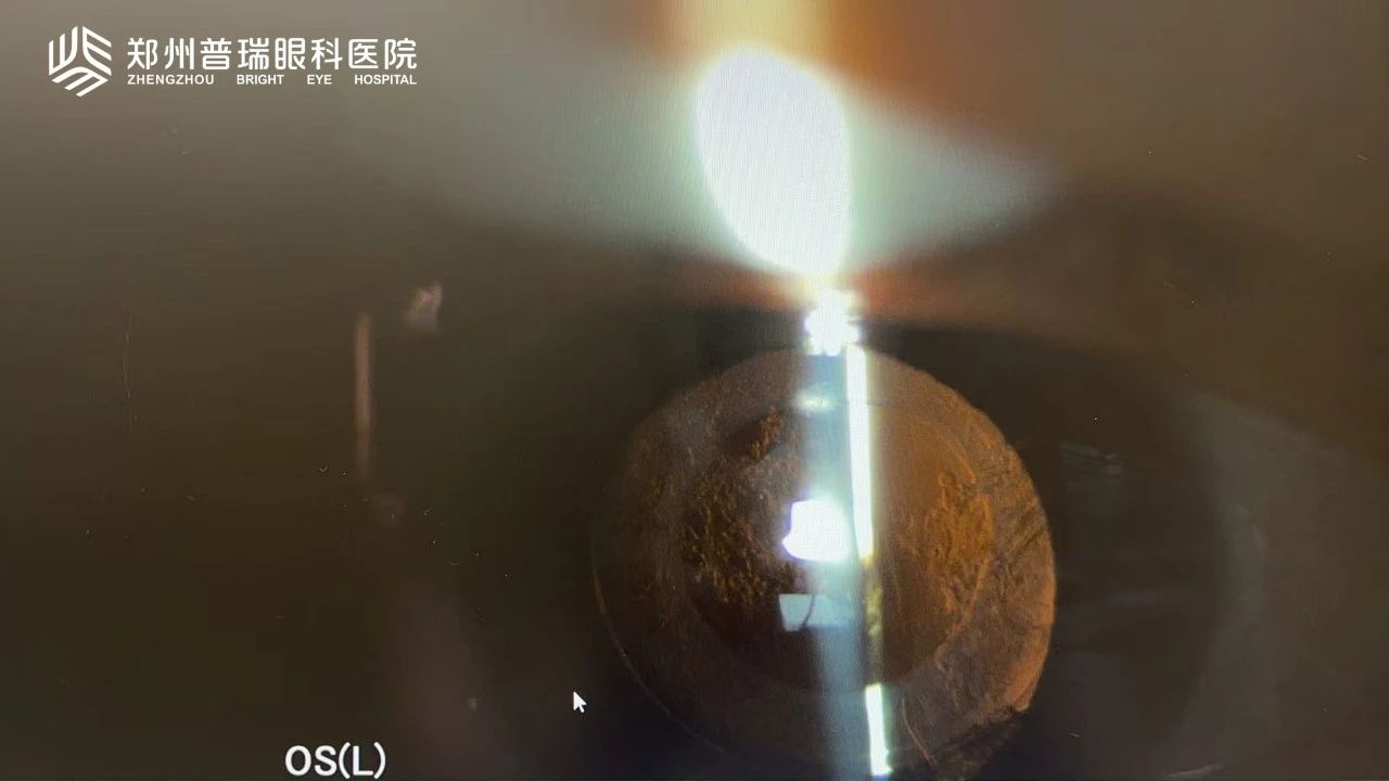 白內(nèi)障術(shù)后視力又下降？6大原因多方面解析！